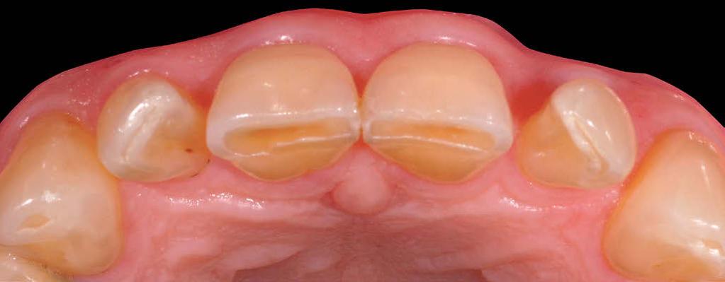 Diagnostic mock-ups as an objective tool for predictable outcomes with porcelain laminate veneers