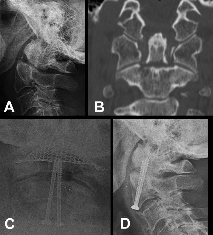 O doente com fractura luxação C6 foi ainda submetido a artrodese C5-C6-C7 com placa cervical anterior e aplicação de enxerto autólogo no Figura 2. Osteossíntese do processo odontoide com um parafuso.