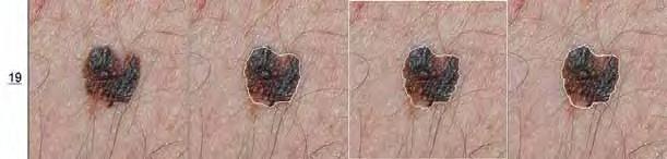 4.1 Comparação de três métodos de extração de características de lesões de pele 82 (... Cont) Resultados obtidos com o método desenvolvido neste trabalho.