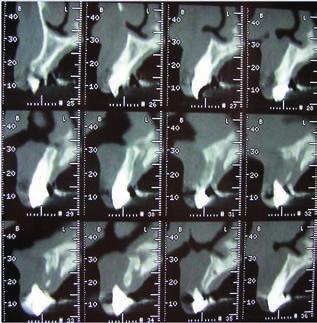 Apesar de a tomografia computadorizada ter sido significante no campo do diagnóstico e planejamento no tratamento com implantes, suas limitações como o custo financeiro da técnica e a alta dose de