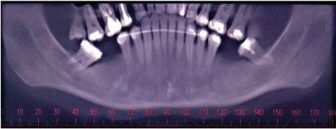 Imageologia associada ao planejamento cirúrgico para implantoterapia Figura 9 - Vista panorâmica da mandíbula na tomografia computadorizada de feixe cônico.