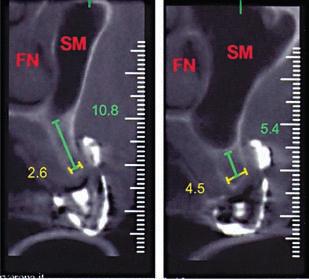 tomográfico para planejamento de implantes. Por exemplo, os clínicos da Suécia raramente complementavam seus exames em pacientes com mandíbulas edêntulas com o auxílio de tomografias.