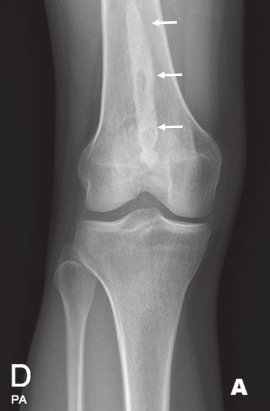 Figura 10. Mulher, 46 anos, com história de hérnia de disco L5-S1, com achado acidental de cisto de herniação sinovial (seta) no colo femoral direito, visualizado na radiografia e na RM.
