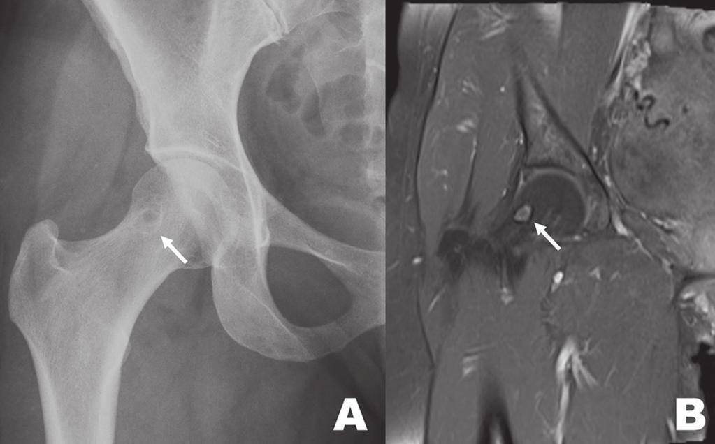 Feita radiografia de membros inferiores para investigação de assimetria entre os membros, com achado adicional de alteração textural com esclerose óssea linear (setas) no contorno distal e posterior