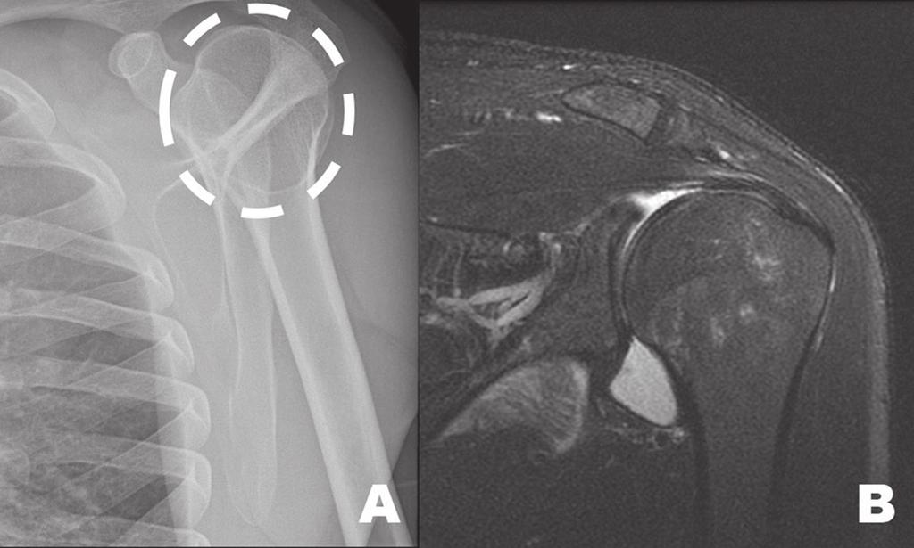 Figura 12. Homem, 22 anos, com dor no ombro esquerdo após trauma. A RM da região axilar esquerda (A) demonstra lesão tumoral (seta) envolvendo os vasos e feixes neurais.