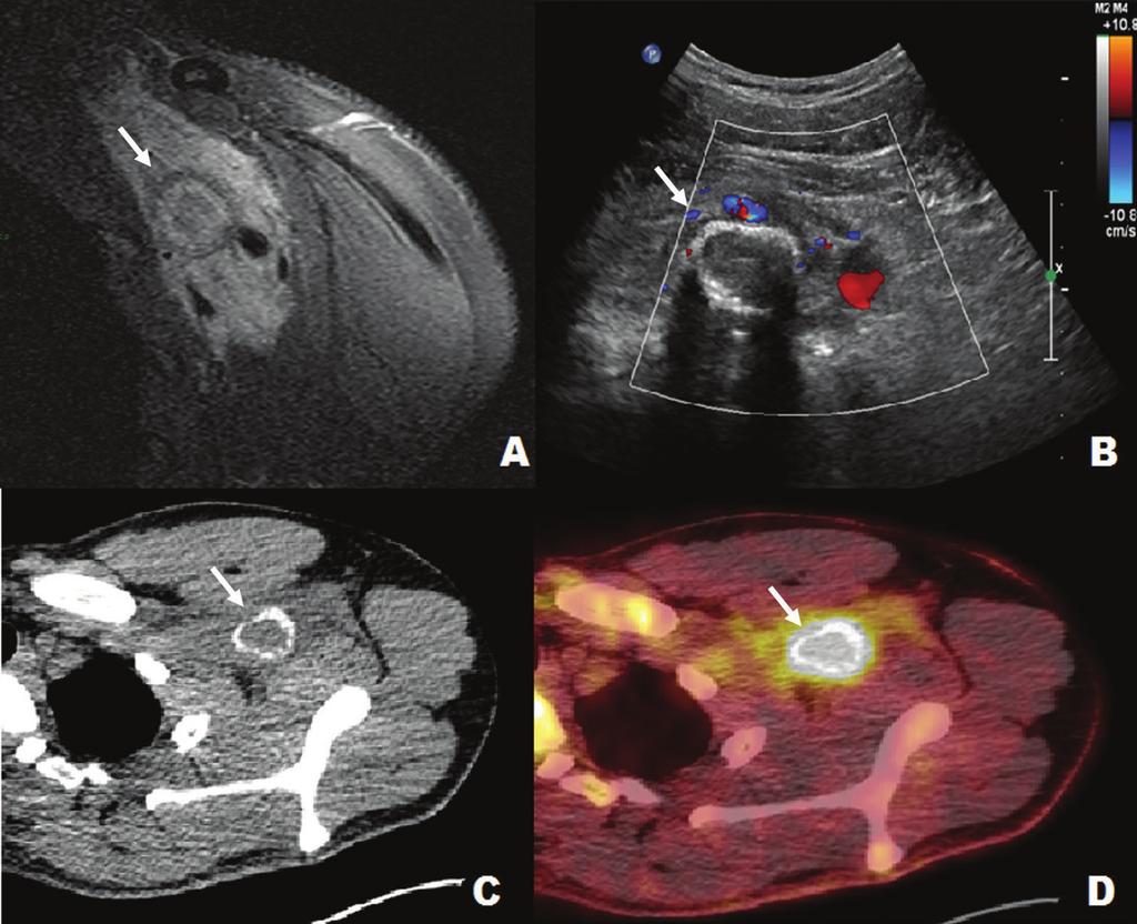 A tomografia por emissão de pósitrons (C) e a TC (D) demonstram lesão infiltrativa (seta) na região retropeitoral/axilar esquerda, com acentuado aumento da atividade glicolítica.