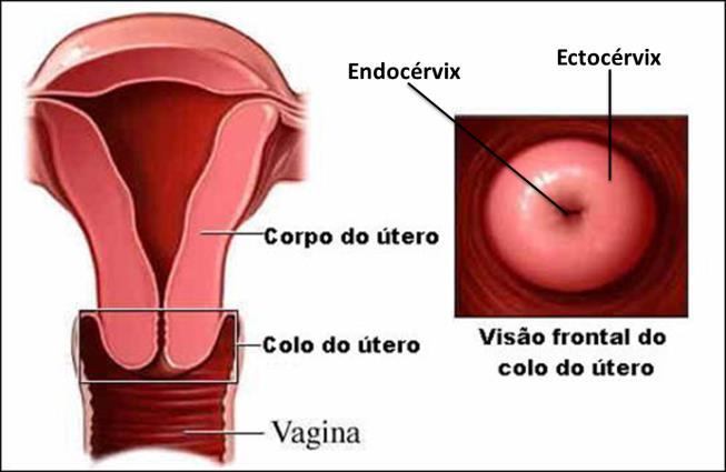 Figura 1 Divisão do útero entre colo e corpo, e as subdivisões do colo: endocérvix e ectocérvix.