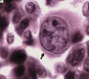 Figura 3 Esfregaço cervicovaginal, Papanicolaou, exibindo células metaplásicas escamosas maduras (esquerda) e células metaplásicas