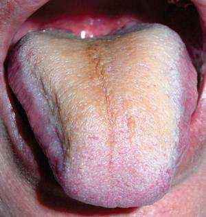 A saburra língual formada mantém-se aderida por três fatores principais: 1-Aumento da concentração de mucina na saliva, 2-Células epiteliais descamadas, 3-presença de microrganismos anaeróbicos