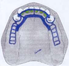 5 Caderno de Planejamento em Prótese Parcial Removível CASO 02 A B Pilares 34 e 44: grampo circunferencial Modelo Anel (Anelar), com Placa Proximal distal, Apoio Oclusal Mesial, promovendo Alavanca