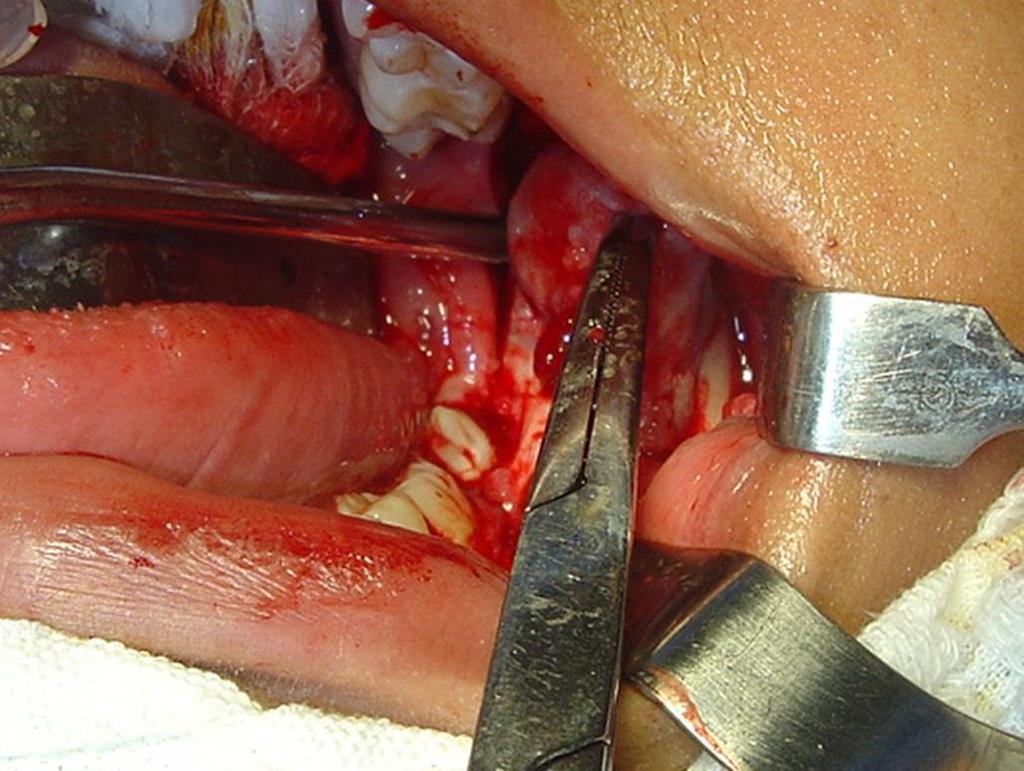 16 Figura 4: Transcirúrgico de enucleação