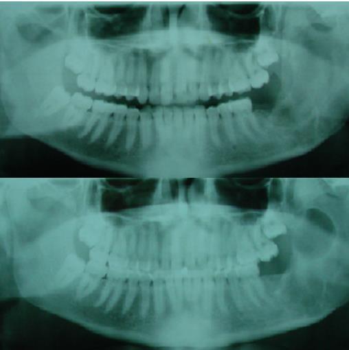 17 Figura 6: Imagem radiografica do Ameloblastoma Unicístico quando diagnosticado (a) e sua reincidência após 3 anos(b).