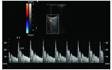 42 IRAO menores que 0,56 com evidência clínica de PRES (OR 12,67; IC 95% 4,08 39,39; p< 0,0001), sugerindo que o IRAO seja um potencial biomarcador de PRES em casos de PE grave.