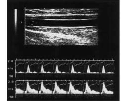 49 FIGURA 4 - Imagem ultrassonográfica da artéria braquial (painel superior) e das ondas do Doppler obtidas da artéria braquial em repouso (painel inferior, primeira imagem) e durante a hiperemia