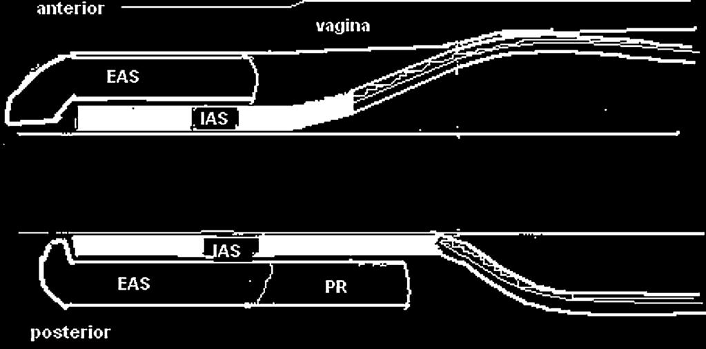 34 FIGURA 5 - Desenho esquemático para identificar a localização da lesão esfincteriana resultante do tratamento com sedenho cortante.