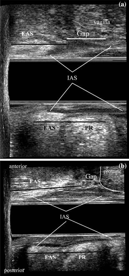 encontradas nas regiões anterior e posterior. FIGURA 6 - Representação esquemática do canal anal e junção anorretal feminino.