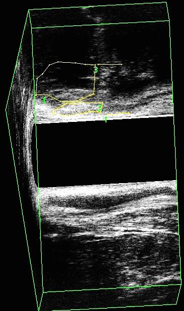3 1 2 4 FIGURA 8 - Corte oblíquo do canal anal pelo US 3D de paciente após tratamento de fístula anterior com sedenho cortante.