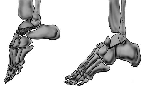 INTRODUÇÃO O pé equino rígido é uma condição de incapacidade do movimento de dorsiflexão da articulação do tornozelo e também de limitação da movimentação passiva, com consequente encurtamento do
