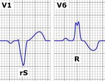 bradidisritmias Guidelines de IC ESC (2012) Guidelines de Pacing ESC (2013) Cansaço como