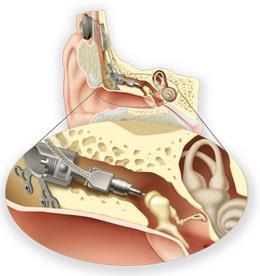 Todos os componentes incluindo o microfone e o processador de fala estão implantados na região retro auricular do paciente. Indicado para surdez neurossensorial, de condução ou mista.