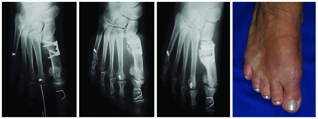 Osteotomia cuneiforme de adição na base do primeiro metatársico para o tratamento do hálux valgo moderado e intenso: fixação com placas de baixo perfil A B C D Figura 3 - Pseudartrose: (A) imagem