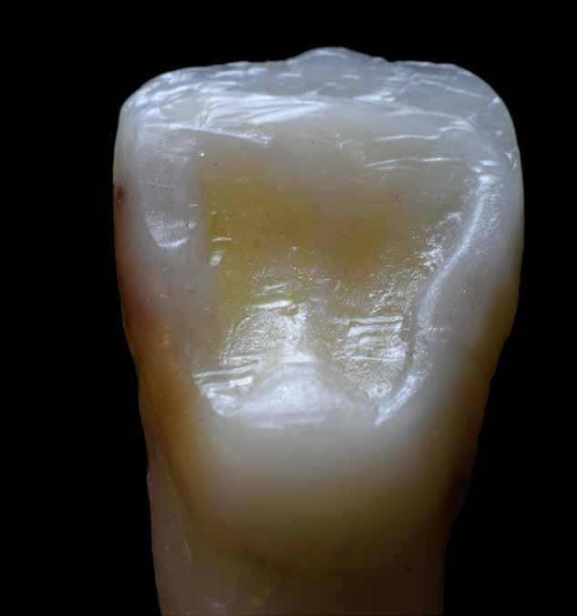 Na face palatina, as cristas marginais estão mesialmente e distalmente confluentes com o cíngulo e são essenciais na determinação das formas dos dentes.