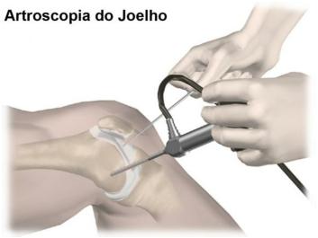 Exercícios para amplitude de movimento devem ser iniciados imediatamente com o objetivo de ajudar seu joelho dolorido a recuperar mobilidade completa.