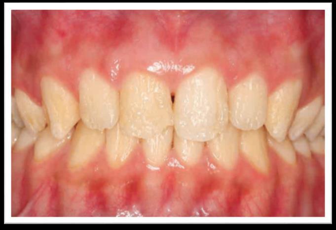 52 Fonte 3 - SILVA; SOUSA, 2012 1. Qual o seu diagnóstico para esse dente? ( ) Dente Hígido ( ) Fluorose ( ) Amelogênese Imperfeita ( ) Hipoplasia de Esmalte ( ) Lesão de cárie 2.