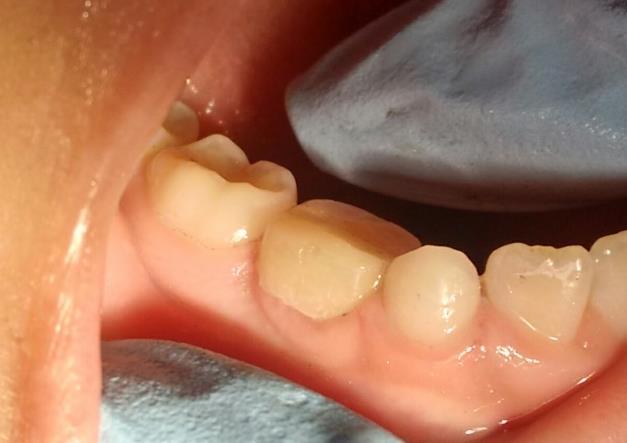 3 Intervenção terapêutica Após profilaxia dentária profissional, selecionou-se e cimentou-se banda ortodôntica no dente 84 com cimento de ionômero de vidro encapsulado fotopolimerizável (Riva Ligh