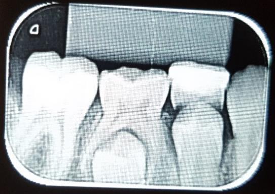 3 Discussão Baseados em estudo de Lavanaugh e Croll (1994) nos propomos a investigar se seria possível a reabilitação em uma única sessão de um dente decíduo anquilosado, utilizando cimento de
