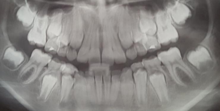 O principal achado após doze meses de acompanhamento foi a boa adesão e resistência do material frente aos esforços mastigatórios e consequentemente a rizólise do dente decíduo, proporcionando a