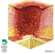 tendão não são visíveis. Estágio IV: Perda total da espessura dos tecidos da pele com exposição de músculo, osso e/ou tendão.
