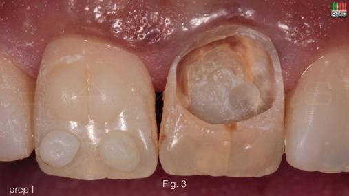 final da cor da restauração desde que o valor de ambos dentes seja semelhante.