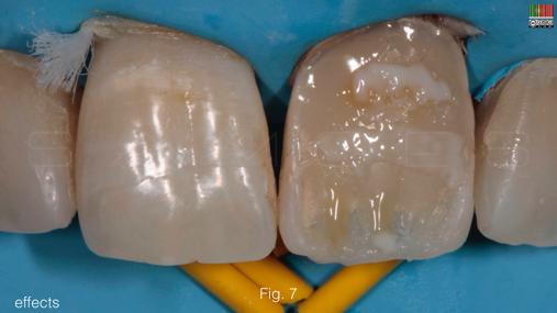 mamelões com resina de dentina de croma 3 Fig 7 Foram aplicadas