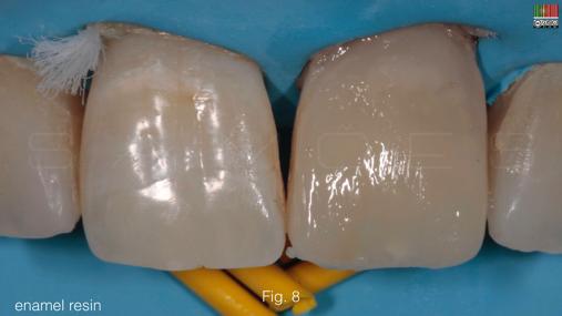 dentinário e bordo incisal, respectivamente Fig 8 Última camada