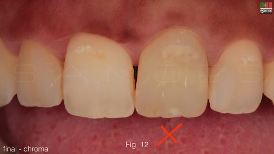 INCORRECTA integração da restauração do ponto de vista da sua CROMA Fig 13 Análise com
