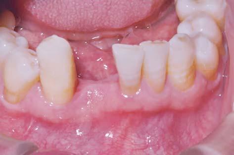 TABELA 1 CLASSIFICAÇÃO DO BIOTIPO PERIODONTAL Biotipo periodontal Tipo I (40% pacientes) Tipo II (10% pacientes) Tipo III (20% pacientes) Tipo IV (30% pacientes) Características clínicas Tecido
