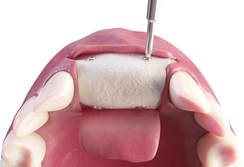 Expansão longitudinal da crista óssea com instrumentos cirúrgicos precisos. Recobrimento de defeitos ósseos para correções de volume ósseo insuﬁciente.