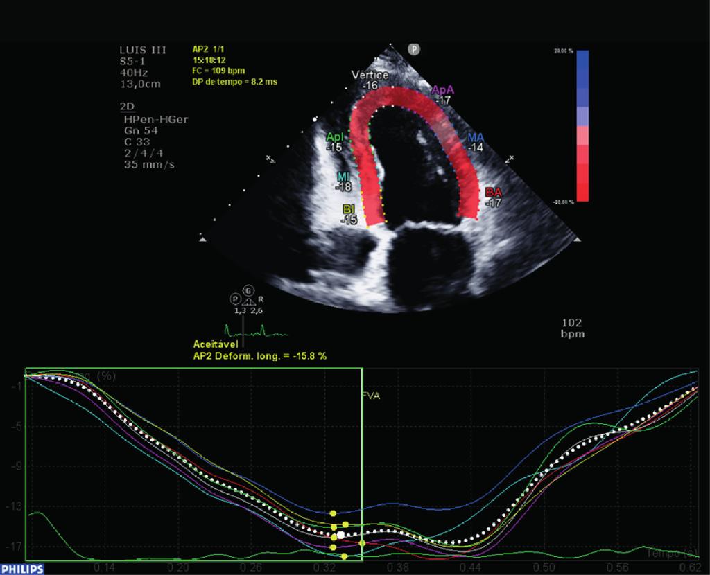 Figura 2 Strain longitudinal apical 2 câmaras do