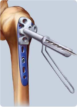 Isto ajuda a fixação da placa ao o osso, garantindo uma aproximação e interface entre a placa e o osso.