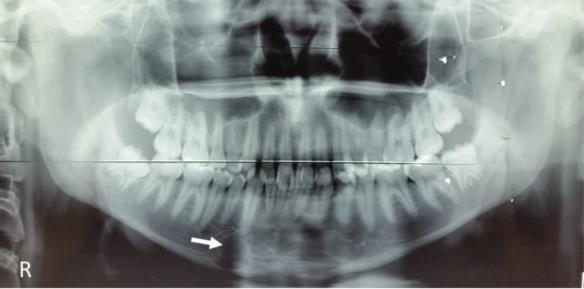 Figura 3 - Radiografia oclusal parcial da mandíbula evidenciando ausência de expansão das corticais ósseas vestibular e lingual no sítio da lesão (vide setas).