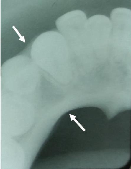Figura 1 Radiografia panorâmica inicial evidenciando lesão osteolítica (vide seta), unilocular em região anterior do corpo da mandíbula com formato arredondado e margens bem delimitadas por uma linha