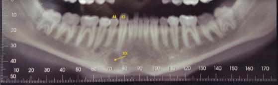 A radiografia periapical revelou radiopacidades no interior da lesão, semelhantes a trabéculas ósseas, bem como integridade da lâmina dura no ápice do dente 43 (Figuras 2A e 2B).