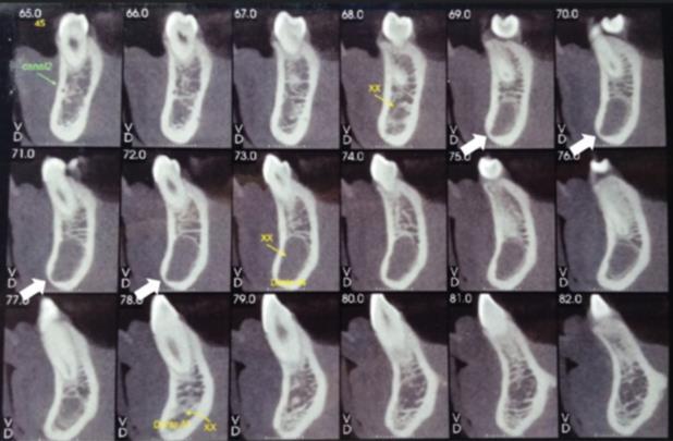 Figura 8 Radiografia periapical (acompanhamento de 10 meses): nota-se estabilidade da lesão com maior riqueza de detalhes (vide seta).