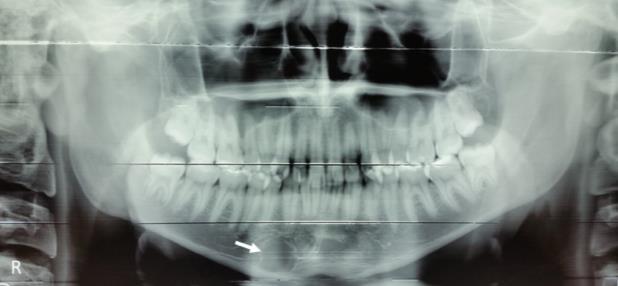 Os achados tomográficos corroboraram a hipótese de COS. Dessa forma, uma abordagem conservadora foi adotada, realizando-se o acompanhamento clínico e radiográfico da lesão.