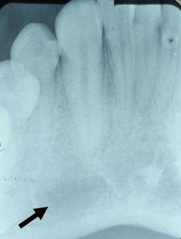 As radiografias panorâmica dos maxilares (Figura 7) e periapical do sitio de interesse (Figura 8) evidenciaram estabilidade da lesão.