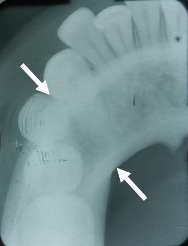 Figura 7 Radiografia panorâmica (acompanhamento de 10 meses): evidência de estabilidade da lesão (vide seta).