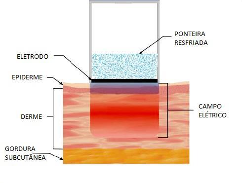 inicia a partir do aquecimento volumétrico do tecido profundo, onde resultará uma contração imediata dos colágenos através da quebra de pontes de hidrogênio deste componente dérmico.