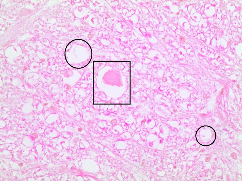 Figura 1. Caprino mestiço com Hipocuprose. Medula cervical.