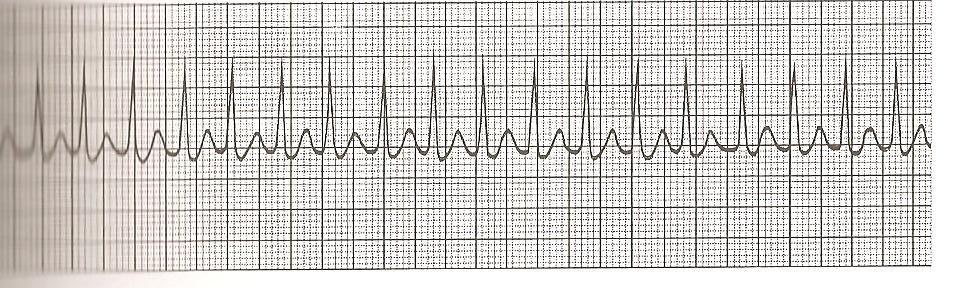 Nos casos mais extremos é pertinente a tentativa da cardioversão elétrica. Freqüências muito altas.